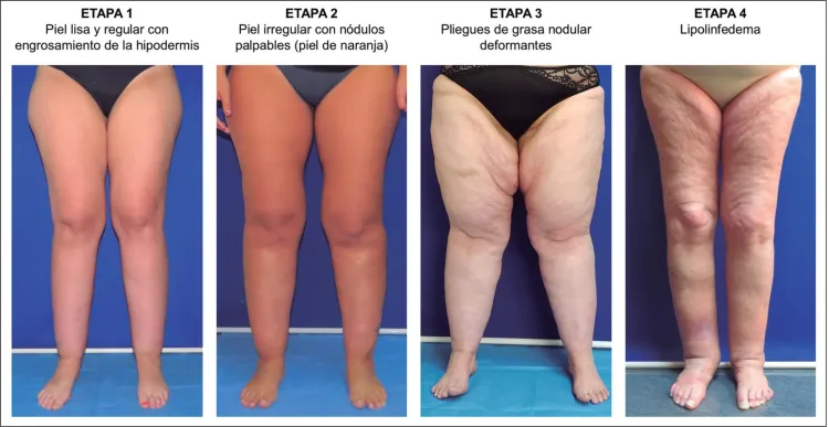 Lipedema y Emociones 